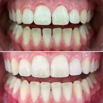 Vorher-Nachher-Vergleich ästhetische Zahnkorrektur mit Invisalign