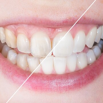Vorher-Nachher-Vergleich von Zähnen nach Bleaching